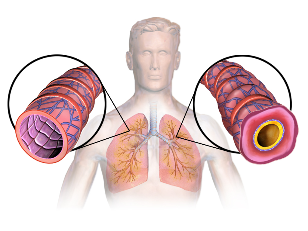 Bronxial astma tutması — nebulizator istifadəsi, salbutamol, ventolin və astma dermanlari ilə müalicə